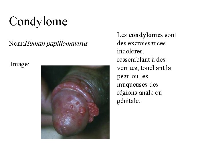 Condylome Nom: Human papillomavirus Image: Les condylomes sont des excroissances indolores, ressemblant à des