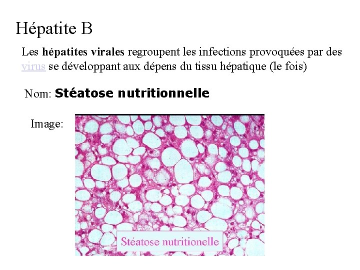 Hépatite B Les hépatites virales regroupent les infections provoquées par des virus se développant