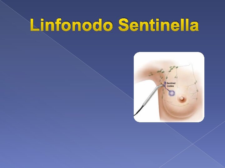 Linfonodo Sentinella 