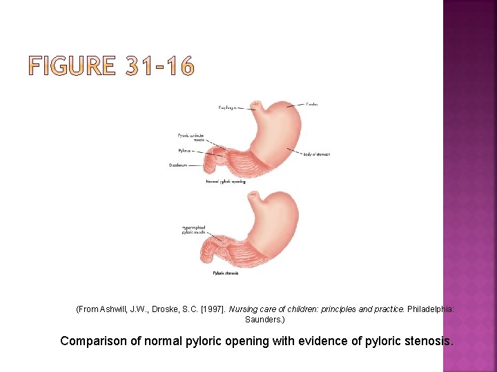 (From Ashwill, J. W. , Droske, S. C. [1997]. Nursing care of children: principles