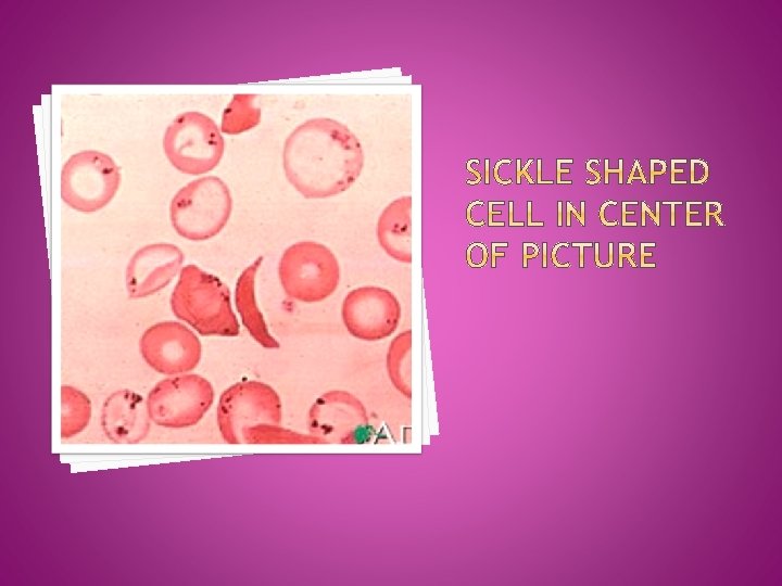 Severe sickling can lead to sickle cell crisis, an acutely painful period that occurs