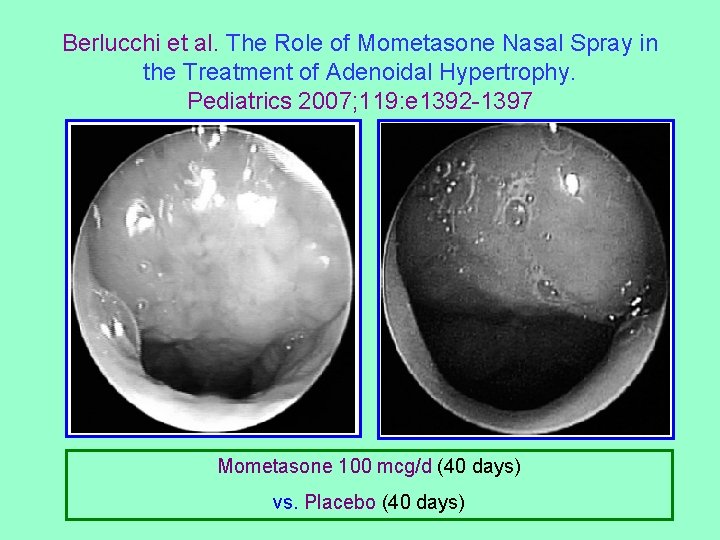 Berlucchi et al. The Role of Mometasone Nasal Spray in the Treatment of Adenoidal