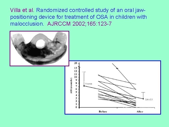 Villa et al. Randomized controlled study of an oral jawpositioning device for treatment of