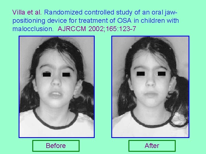 Villa et al. Randomized controlled study of an oral jawpositioning device for treatment of