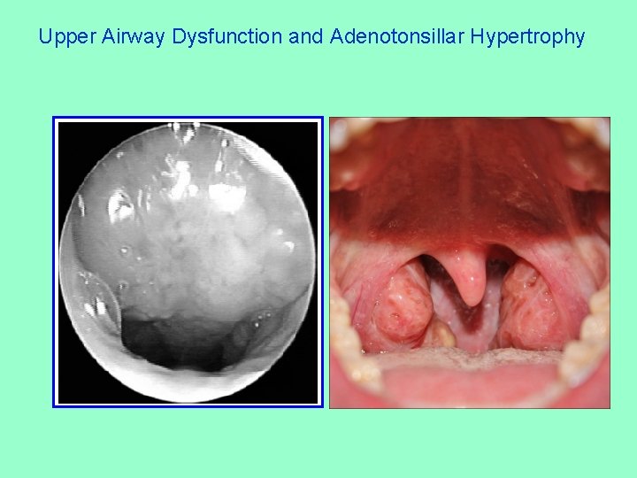 Upper Airway Dysfunction and Adenotonsillar Hypertrophy 