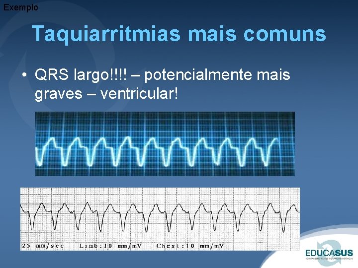 Exemplo Taquiarritmias mais comuns • QRS largo!!!! – potencialmente mais graves – ventricular! 