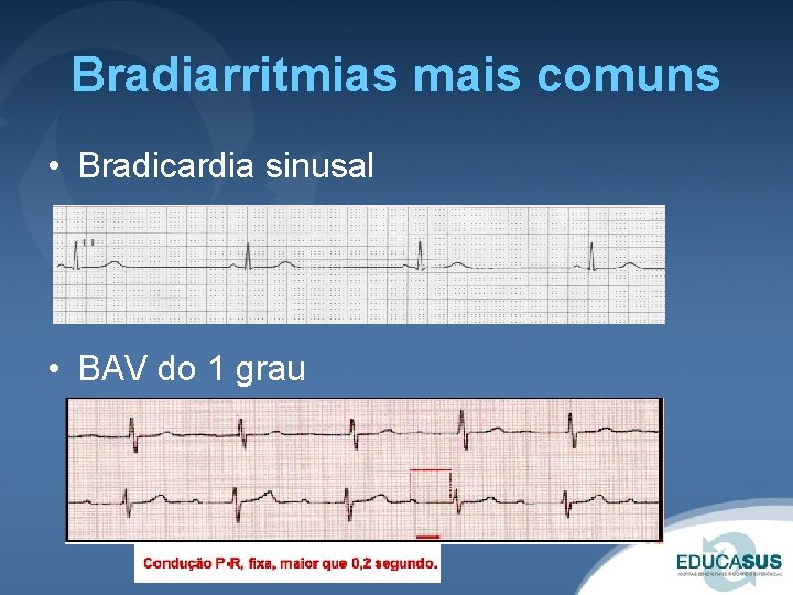 Bradiarritmias mais comuns • Bradicardia sinusal • BAV do 1 grau 