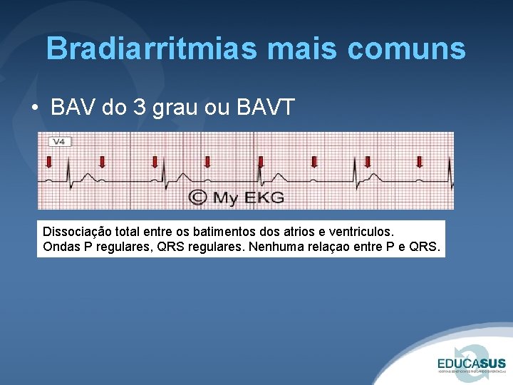 Bradiarritmias mais comuns • BAV do 3 grau ou BAVT Dissociação total entre os