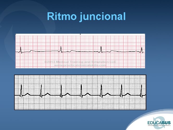 Ritmo juncional 