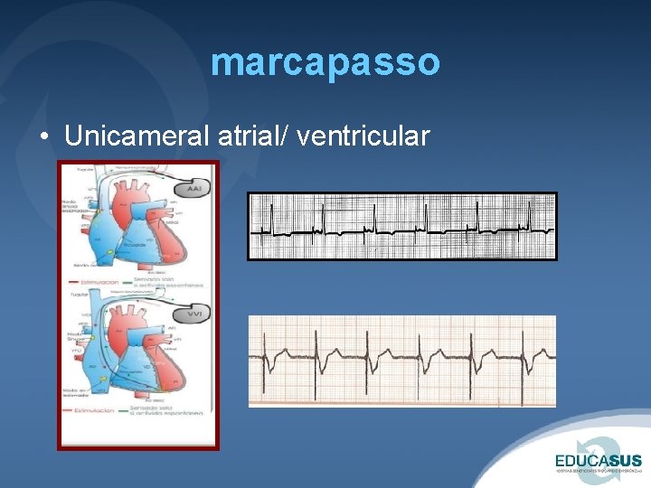 marcapasso • Unicameral atrial/ ventricular 