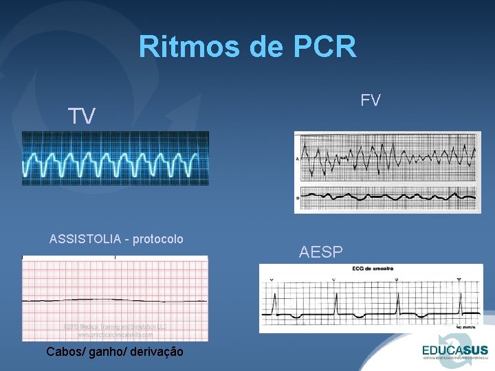 Ritmos de PCR FV TV ASSISTOLIA - protocolo Cabos/ ganho/ derivação AESP 