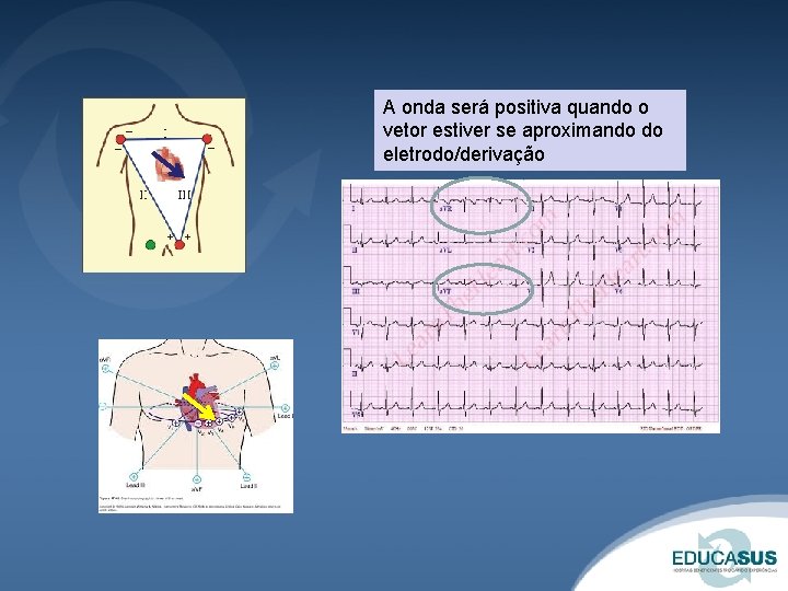 A onda será positiva quando o vetor estiver se aproximando do eletrodo/derivação 