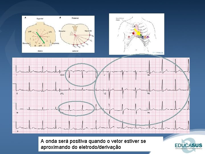A onda será positiva quando o vetor estiver se aproximando do eletrodo/derivação 