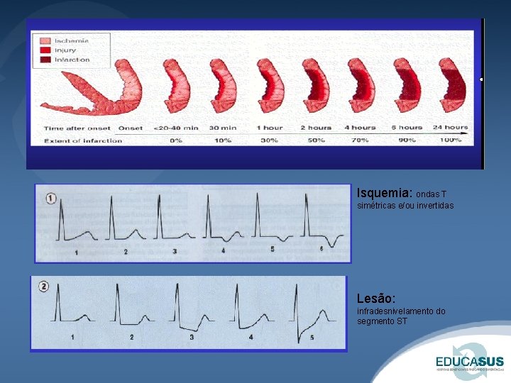 Isquemia: ondas T simétricas e/ou invertidas Lesão: infradesnivelamento do segmento ST 