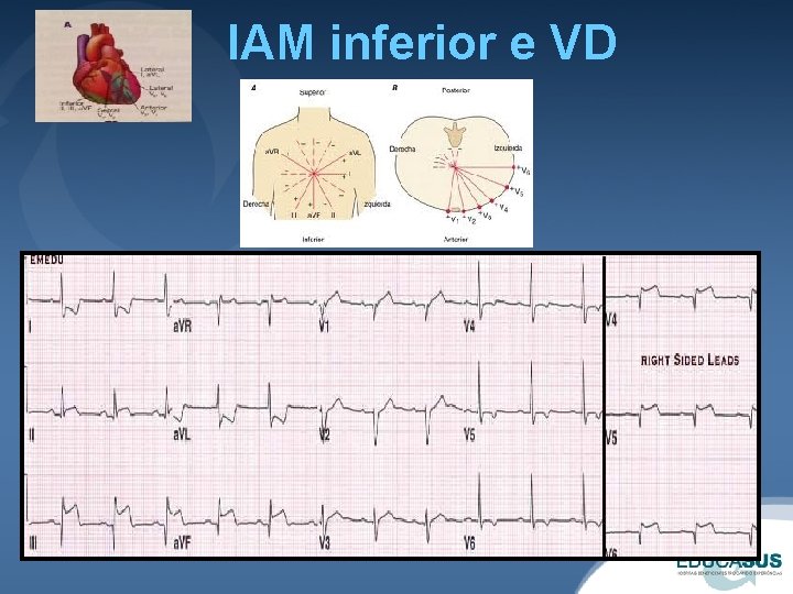 IAM inferior e VD 