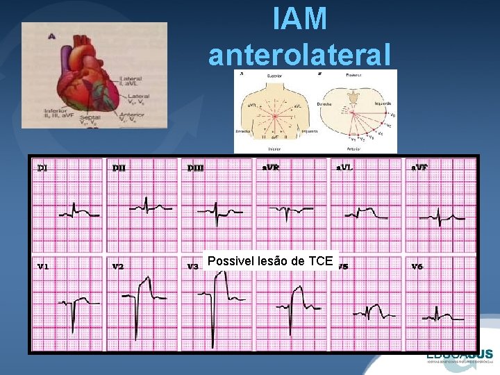 IAM anterolateral Possivel lesão de TCE 