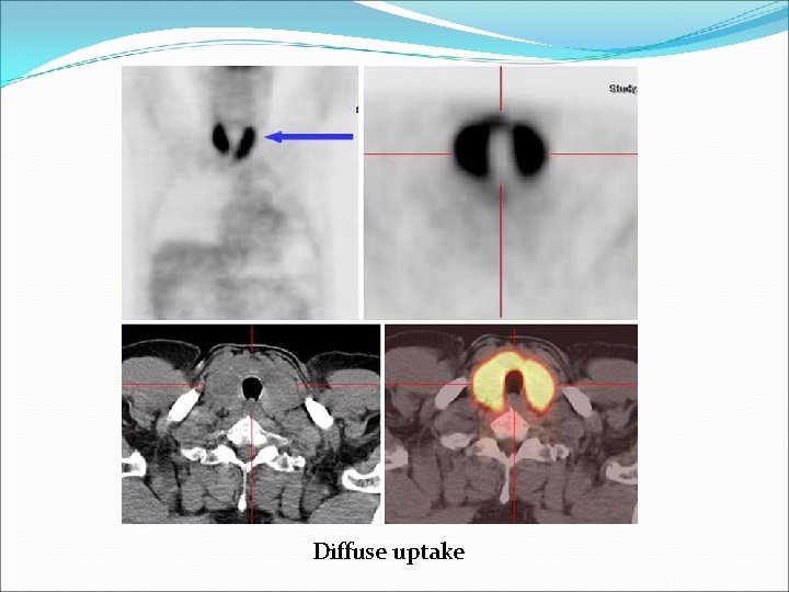 Diffuse uptake 