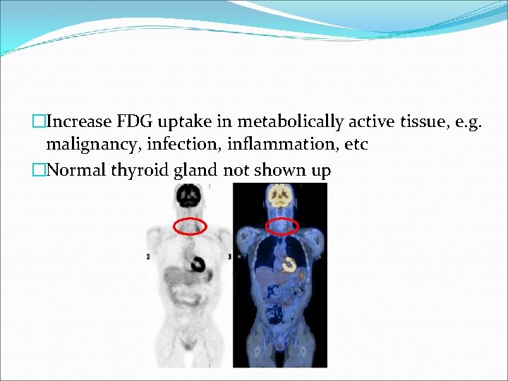 �Increase FDG uptake in metabolically active tissue, e. g. malignancy, infection, inflammation, etc �Normal