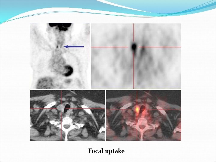 Focal uptake 