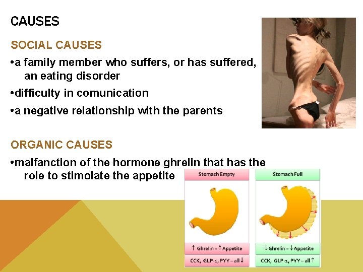 CAUSES SOCIAL CAUSES • a family member who suffers, or has suffered, an eating