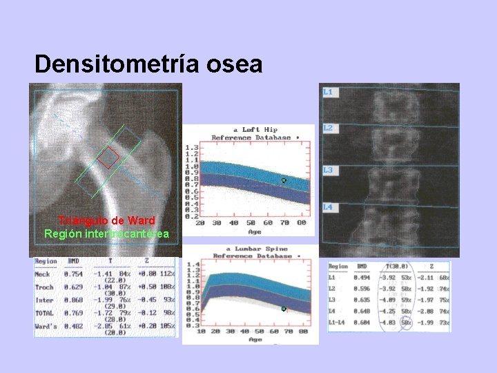 Densitometría osea Triángulo de Ward Región intertrocantérea 