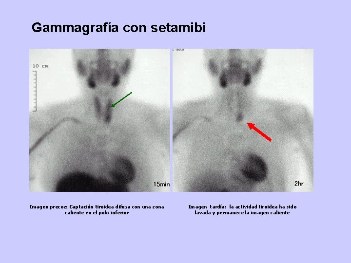 Gammagrafía con setamibi Imagen precoz: Captación tiroidea difusa con una zona caliente en el