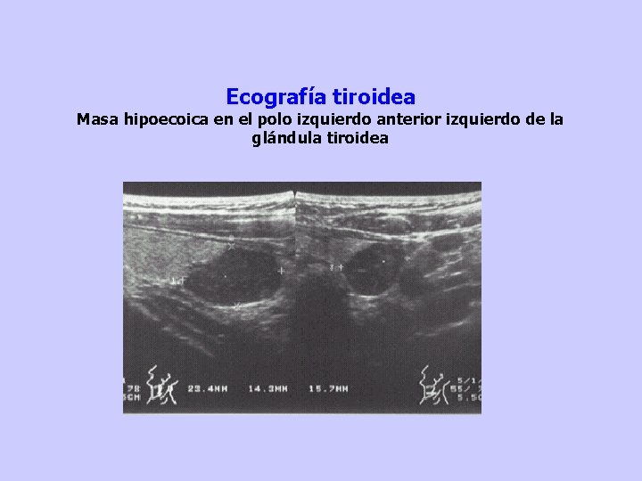 Ecografía tiroidea Masa hipoecoica en el polo izquierdo anterior izquierdo de la glándula tiroidea