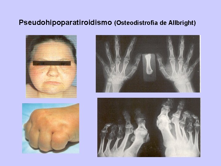 Pseudohipoparatiroidismo (Osteodistrofia de Allbright) 