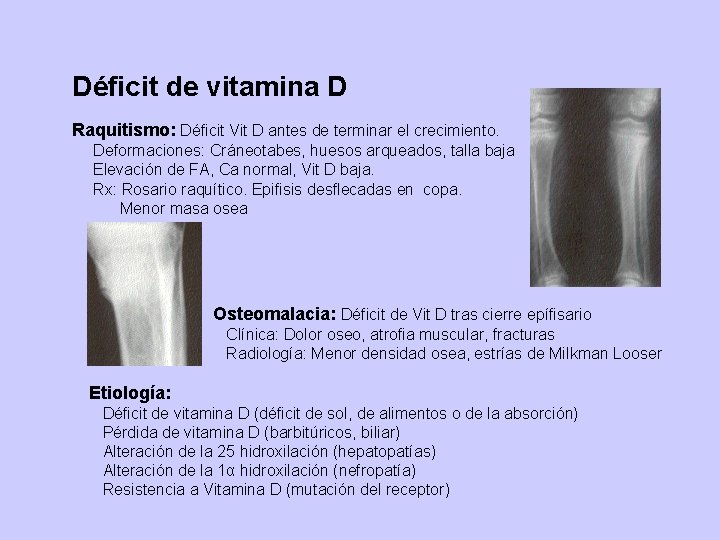 Déficit de vitamina D Raquitismo: Déficit Vit D antes de terminar el crecimiento. Deformaciones:
