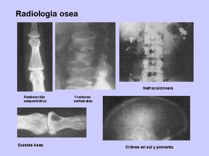 Radiología osea Nefrocalcinosis Reabsorción subperióstica Quistes óseo Fracturas vertebrales Cráneo en sal y pimienta