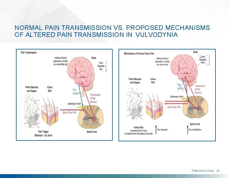 NORMAL PAIN TRANSMISSION VS. PROPOSED MECHANISMS OF ALTERED PAIN TRANSMISSION IN VULVODYNIA Pathophysiology 27