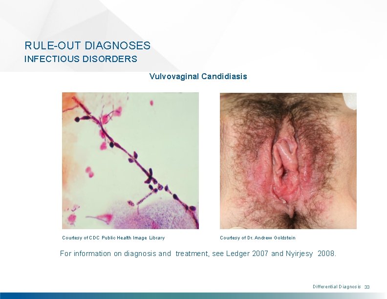 RULE-OUT DIAGNOSES INFECTIOUS DISORDERS Vulvovaginal Candidiasis Courtesy of CDC Public Health Image Library Courtesy