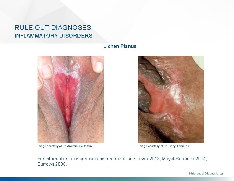 RULE-OUT DIAGNOSES INFLAMMATORY DISORDERS Lichen Planus Image courtesy of Dr. Andrew Goldstein Image courtesy