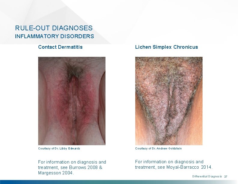 RULE-OUT DIAGNOSES INFLAMMATORY DISORDERS Contact Dermatitis Lichen Simplex Chronicus Courtesy of Dr. Libby Edwards