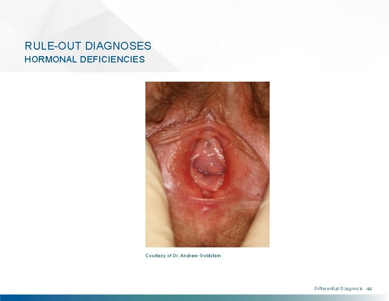 RULE-OUT DIAGNOSES HORMONAL DEFICIENCIES Courtesy of Dr. Andrew Goldstein Differential Diagnosis 44 