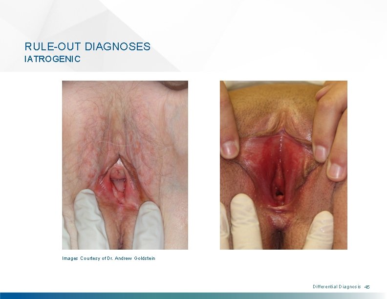 RULE-OUT DIAGNOSES IATROGENIC Images Courtesy of Dr. Andrew Goldstein Differential Diagnosis 45 