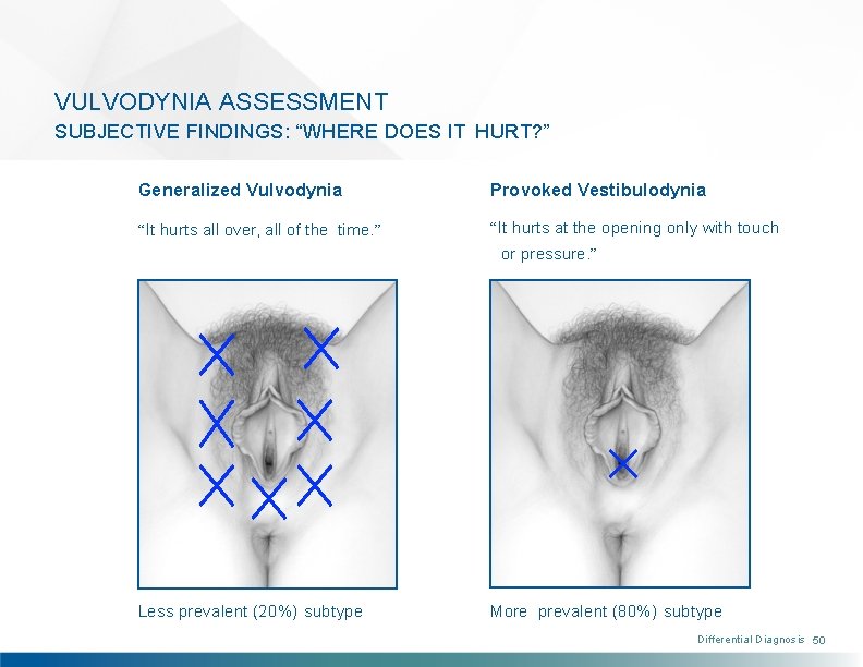 VULVODYNIA ASSESSMENT SUBJECTIVE FINDINGS: “WHERE DOES IT HURT? ” Generalized Vulvodynia Provoked Vestibulodynia “It