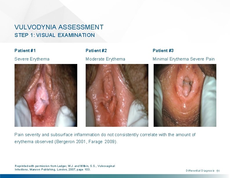VULVODYNIA ASSESSMENT STEP 1: VISUAL EXAMINATION Patient #1 Patient #2 Patient #3 Severe Erythema