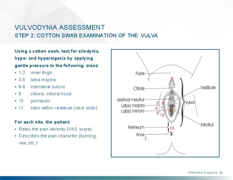 VULVODYNIA ASSESSMENT STEP 2: COTTON SWAB EXAMINATION OF THE VULVA Using a cotton swab,