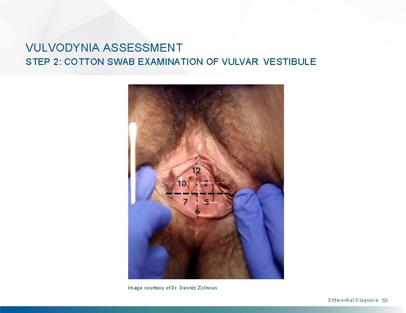 VULVODYNIA ASSESSMENT STEP 2: COTTON SWAB EXAMINATION OF VULVAR VESTIBULE Image courtesy of Dr.