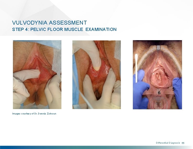 VULVODYNIA ASSESSMENT STEP 4: PELVIC FLOOR MUSCLE EXAMINATION Images courtesy of Dr. Denniz Zolnoun