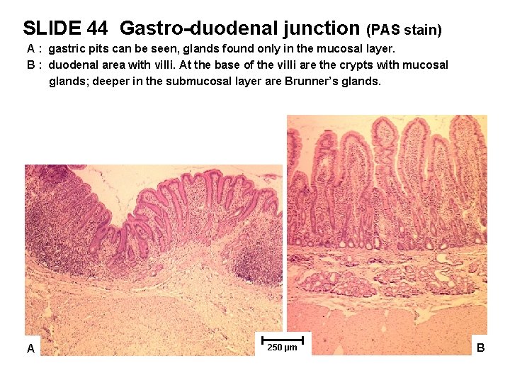 SLIDE 44 Gastro-duodenal junction (PAS stain) A : gastric pits can be seen, glands