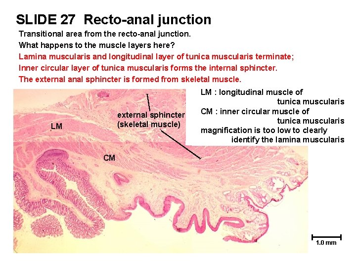SLIDE 27 Recto-anal junction Transitional area from the recto-anal junction. What happens to the