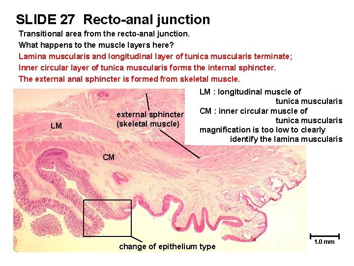 SLIDE 27 Recto-anal junction Transitional area from the recto-anal junction. What happens to the