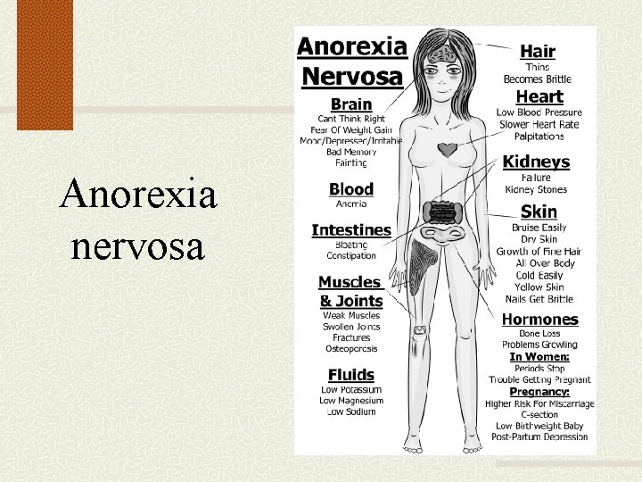 Anorexia nervosa 