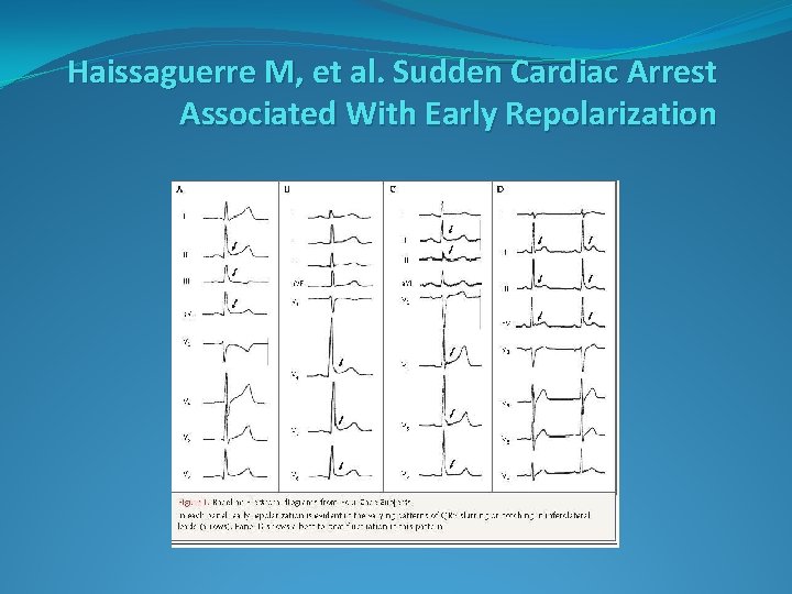 Haissaguerre M, et al. Sudden Cardiac Arrest Associated With Early Repolarization Haissaguerre M, et al. Sudden Cardiac Arrest Associated With Early Repolarization
