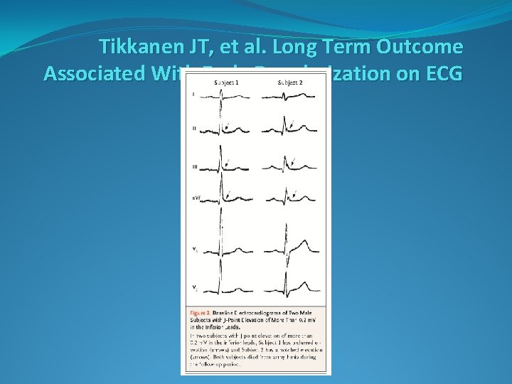 Tikkanen JT, et al. Long Term Outcome Associated With Early Repolarization on ECG Tikkanen JT, et al. Long Term Outcome Associated With Early Repolarization on ECG