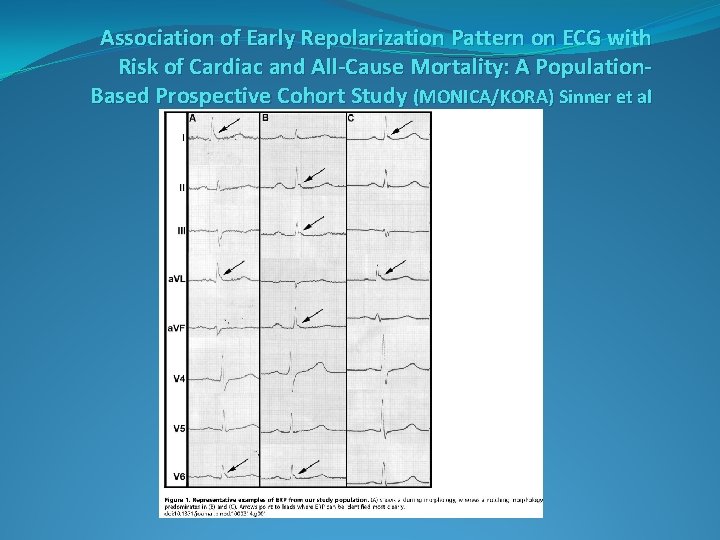 Association of Early Repolarization Pattern on ECG with Risk of Cardiac and All-Cause Mortality: Association of Early Repolarization Pattern on ECG with Risk of Cardiac and All-Cause Mortality: