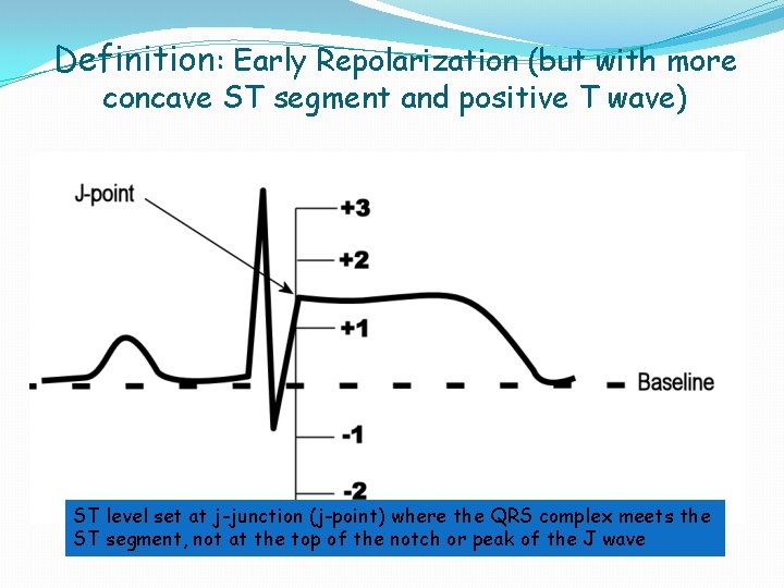 Definition: Early Repolarization (but with more concave ST segment and positive T wave) ST Definition: Early Repolarization (but with more concave ST segment and positive T wave) ST