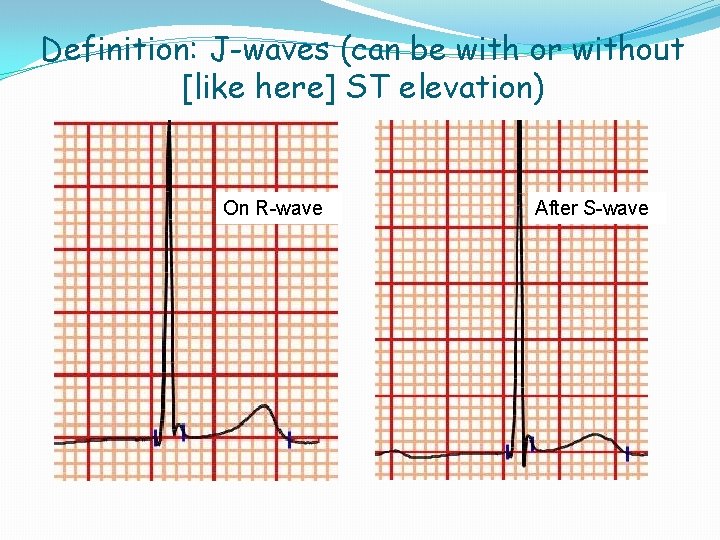 Definition: J-waves (can be with or without [like here] ST elevation) On R-wave After